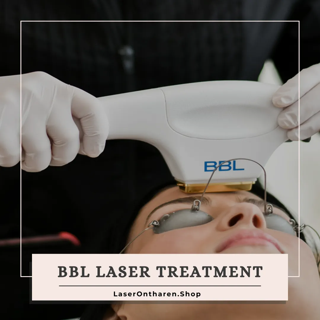BBL laser treatment featured image