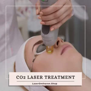 a related image to Blog - CO2 Laser Treatment