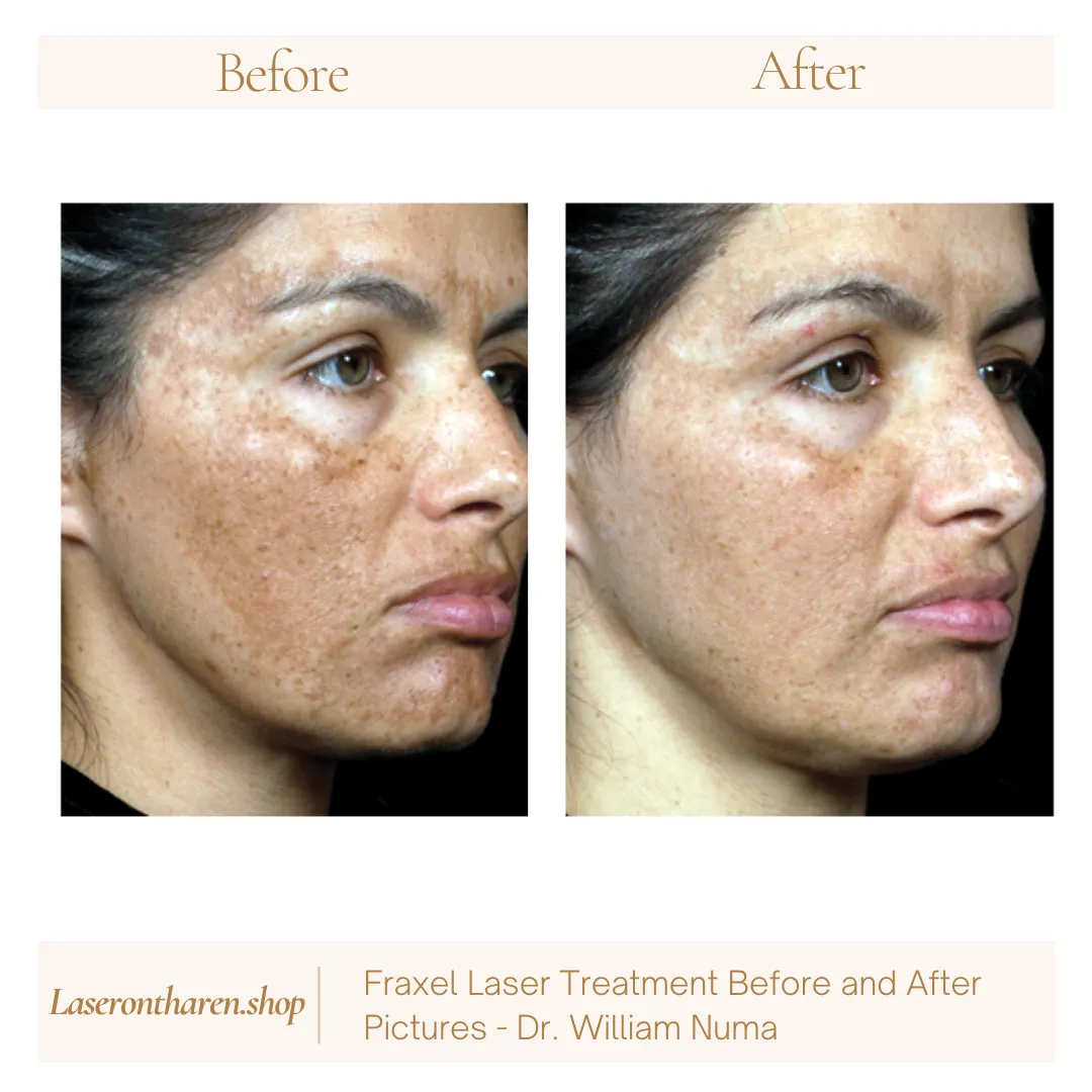 Fraxel Laser Treatment Before and After Pictures