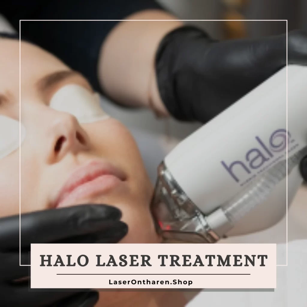 Halo laser treatment