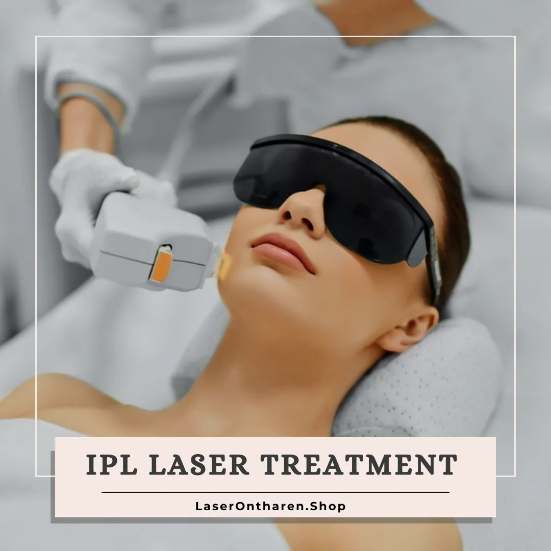 IPL laser treatment featured image