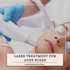 a related image to Blog - Laser Treatment for Acne Scars