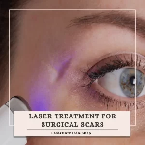 Laser treatment for surgical scars