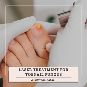 a related image to Blog - Laser treatment for toenail fungus