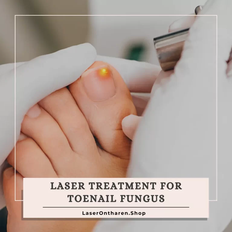 an image related to Laser treatment for toenail fungus - Laser-treatment-for-toenail-fungus