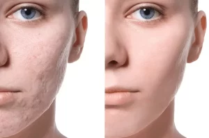Laser Treatment for Acne Scars before & after photo