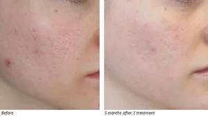 Laser Treatment for Acne Scars Before and After Photo