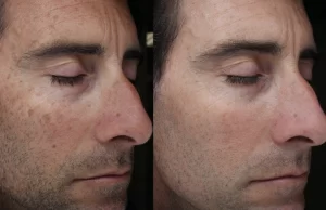 Moxi laser treatment before and after image