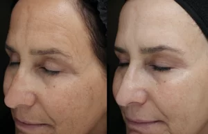 Moxi laser treatment before and after image