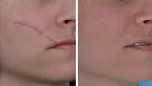 Surgical scars Laser treatment Before and After Photos